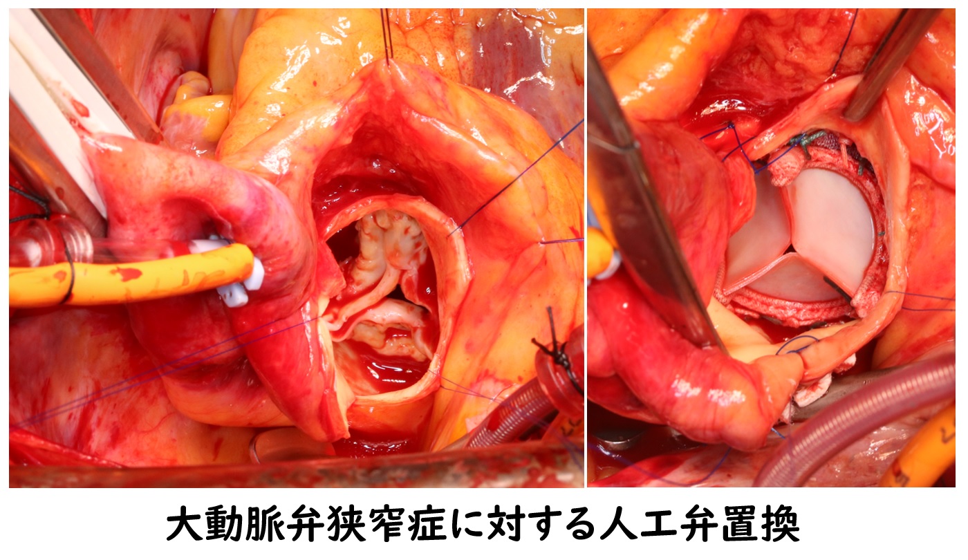 大動脈弁狭窄症に対する人工弁置換
